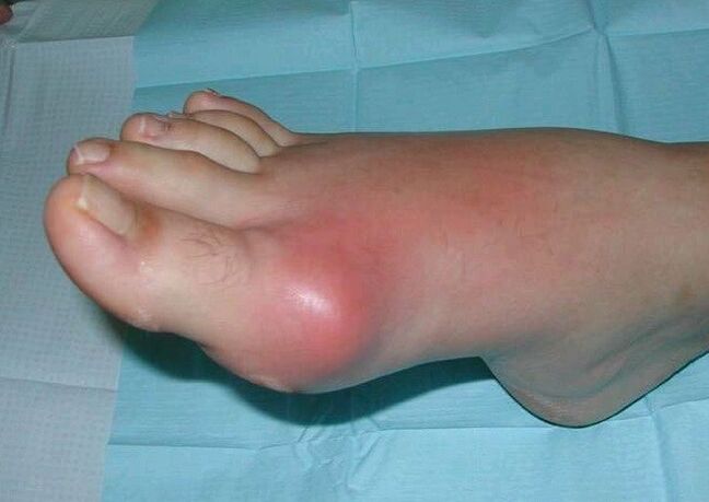 Klinična slika artritisa stopala - oteklina in vnetje