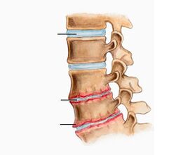 Osteohondroza