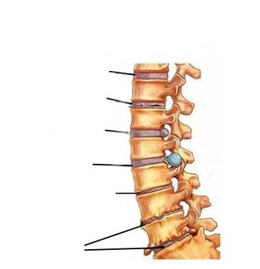stopnje razvoja osteohondroze