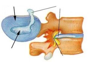 uničenje fibroznega obroča pri cervikalni osteohondrozi