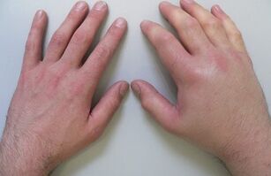 artralgija kot vzrok za bolečino v sklepih prstov
