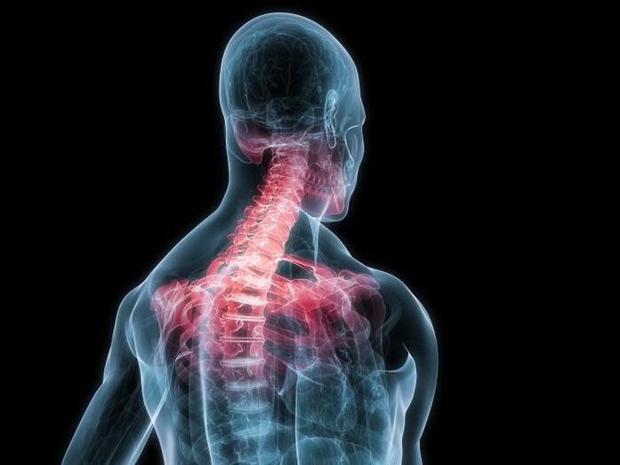 osteohondroza vratne hrbtenice je sprememba medvretenčnih hrustančnih ploščic