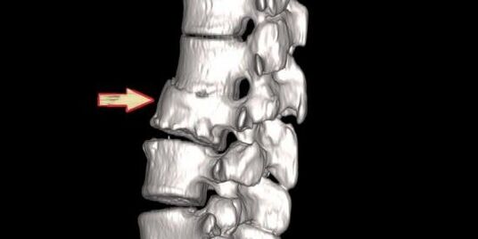 patologija hrbtenice kot vzrok za bolečine v hrbtu