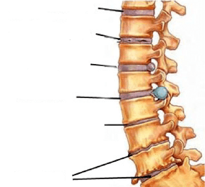 faze razvoja osteohondroze hrbtenice