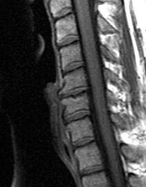 radiografija torakalne hrbtenice