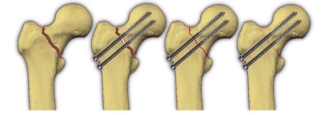 fiksacija kostnega telesa z zatiči za bolečine v kolčnem sklepu