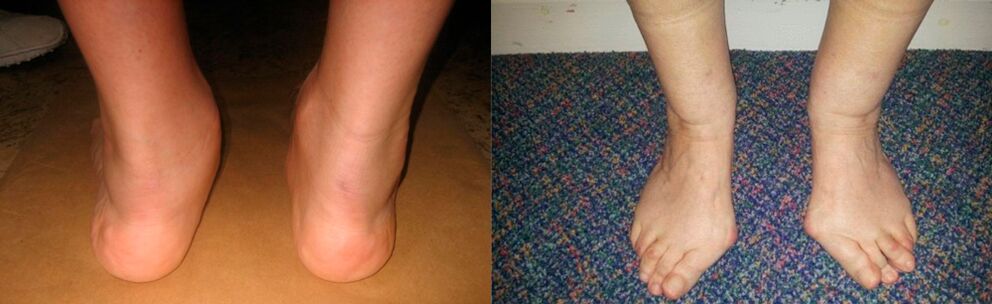Artroza palca na nogi in deformirajoča artroza gležnja