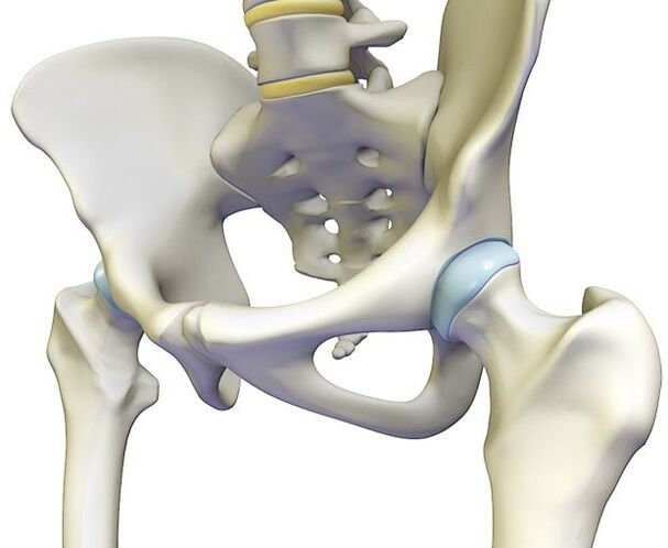 Osteohondroza povzroča ostro bolečino v kolčnem sklepu
