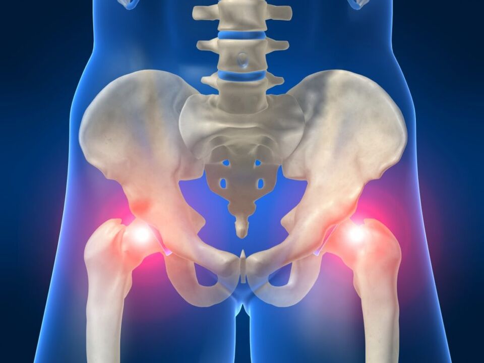 Pri ankilozirajočem spondilitisu je moteča dvostranska bolečina v kolčnem sklepu