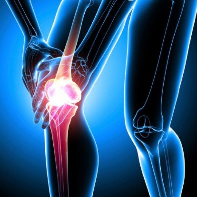 Revmatoidni artritis v napredni fazi lahko povzroči bolečine v kolku