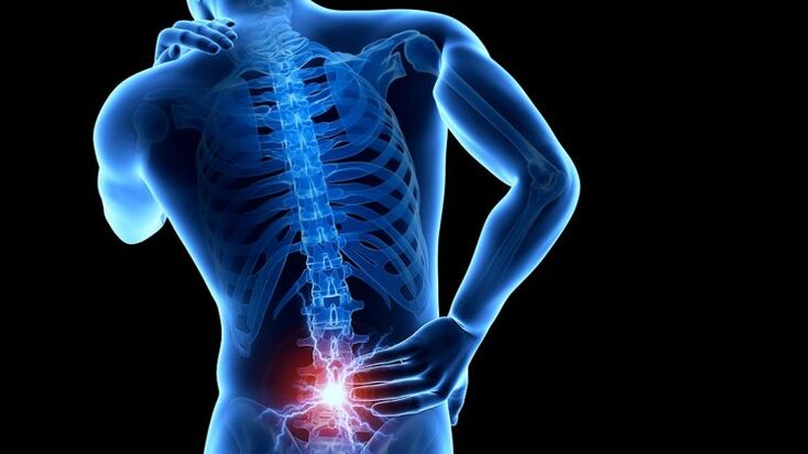 bolečine v hrbtu z ledveno osteohondrozo